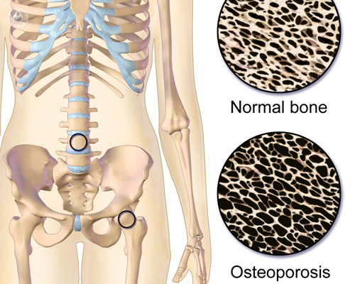 Osteoporosis de Tipo I y Osteoporosis secundaria