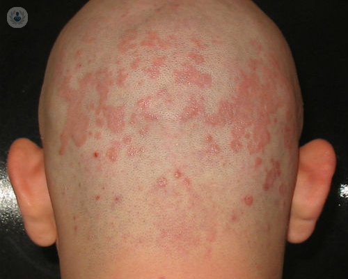 dermatitisseborreica-jpg