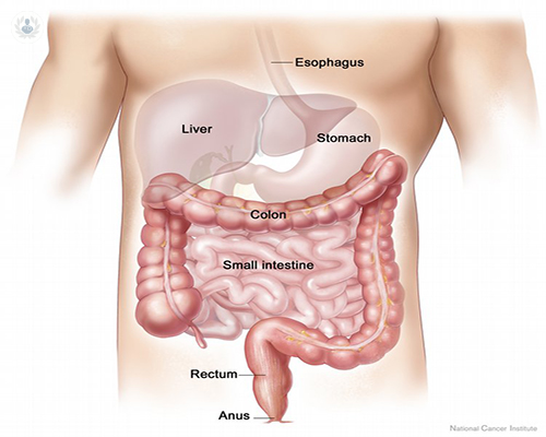 cancer-de-colon