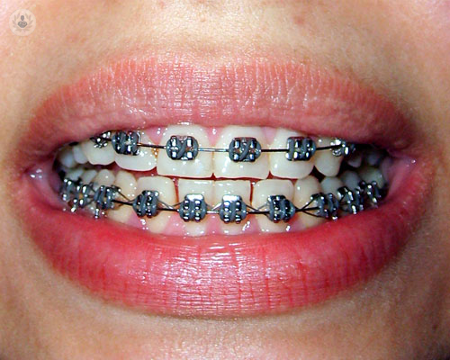 Ortodoncia Moderna