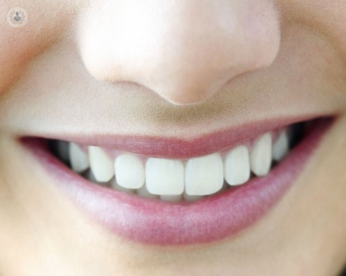 Unos dientes perfectos con implantes dentales