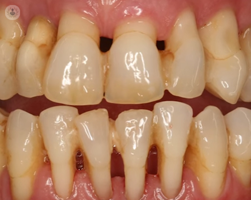 periodontitis-2