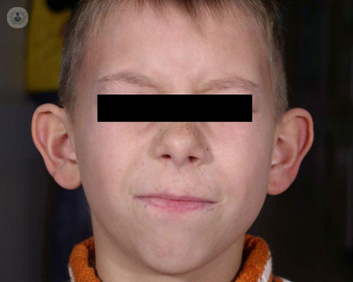 otoplastia-cirugia-para-corregir-la-posicion-de-las-orejas imagen de artículo