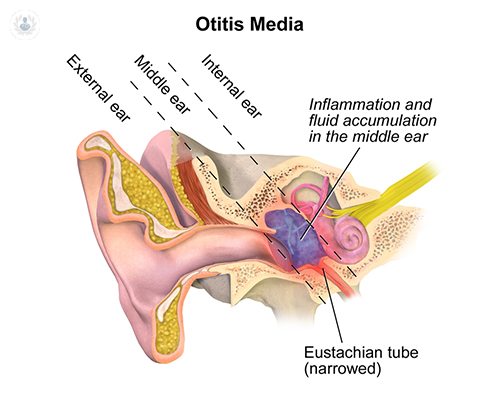 otitis