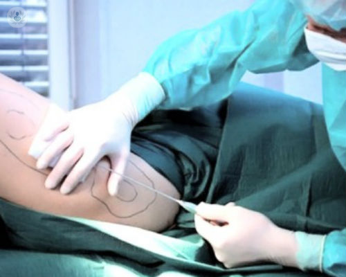 liposuccion imagen de artículo