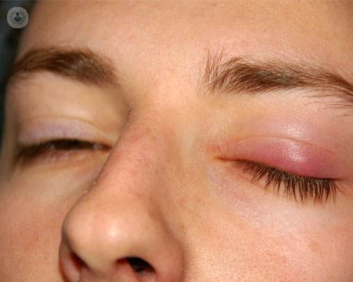 ojos-ptosis