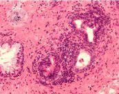 biopsia-prostata