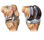 protesis-rodilla