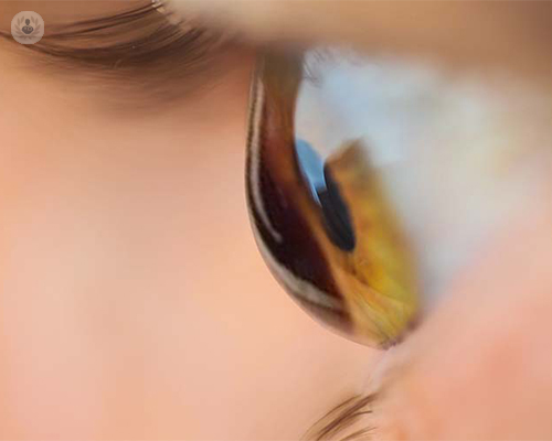 cornea-con-queratocono