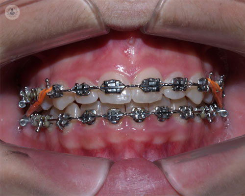 brackets