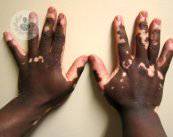 vitiligo-terapia