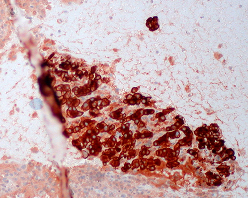 melanoma-avanzado