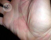 urticaria-ronchas-rojas-mano