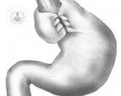 el-reflujo-gastroesofagico-causas-y-tratamiento imagen de artículo