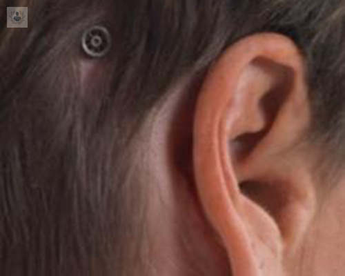 cuatro-preguntas-clave-sobre-la-cirugia-del-implante-osteointegrado imagen de artículo