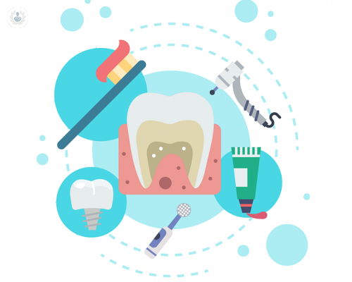 Lo que debe saber sobre implantes dentales
