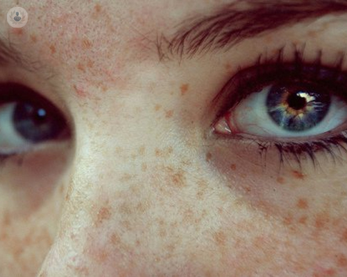 pecas-en-la-cara