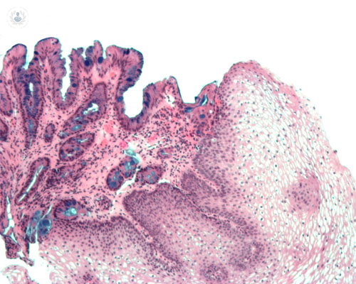 esofago-barrett-halo