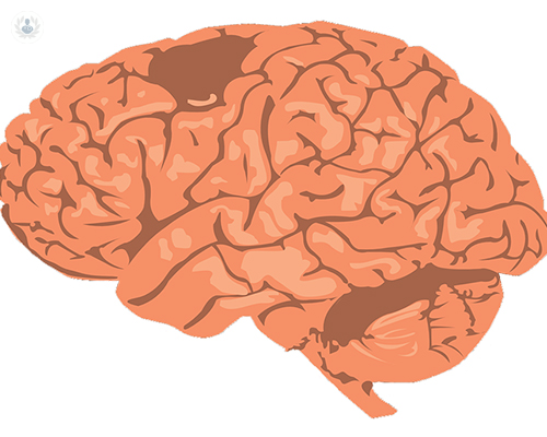 tumores-sistema-nervioso