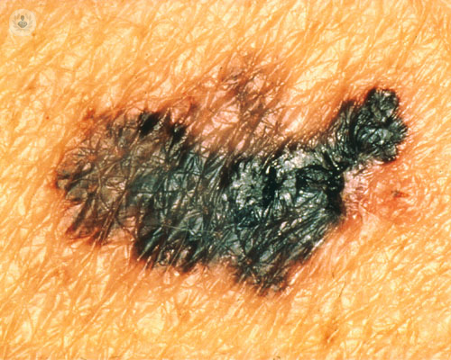 queratosis9238