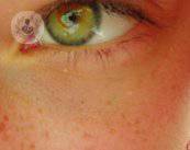 miodesospsias-o-moscas-volantes