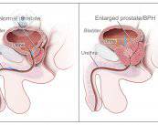 Tratamiento del cáncer de próstata: ¿siempre es necesario?
