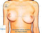 contractura-capsular