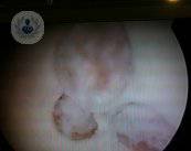 trasplante-de-cartilago