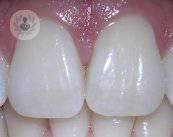 implantes-all-on-four