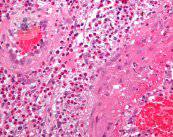 vasculitis