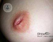 pezon-invertido-tratamiento