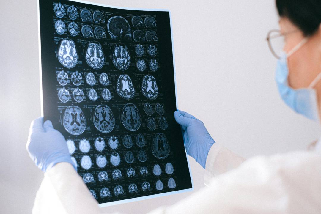 ¿Cómo se diagnostican los Tumores Cerebrales?
