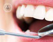 implantes-dentales-como-se-colocan