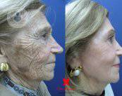 rejuvenecimiento-facial-sin-cirugia-alicante