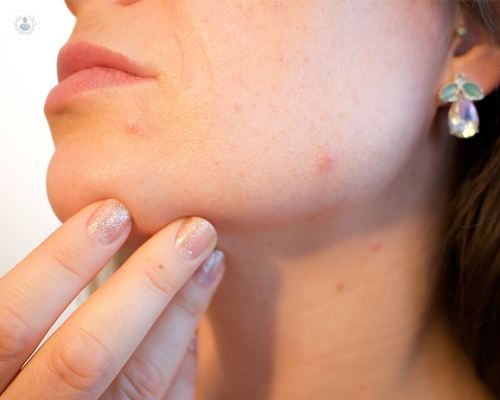 ¿Cómo podemos eliminar el acné juvenil y sus cicatrices?