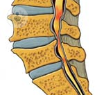 estenosis-de-canal-lumbar
