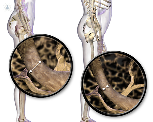 Osteoporosis: su relación con el cáncer, diagnóstico y tratamiento