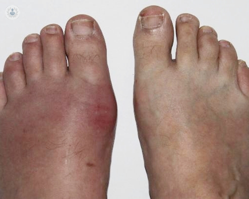 espondilitis