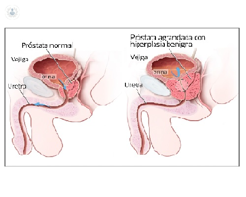 Láser prostático para el adenoma de próstata