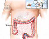 cancer-colorrectal-colonoscopia