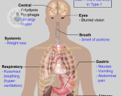 diabetes-sintomas