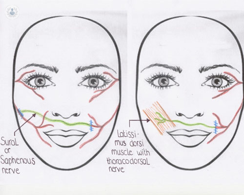 Parálisis facial: ¿qué es y cómo se trata?