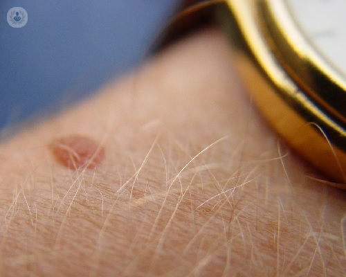 melanoma-prevencion