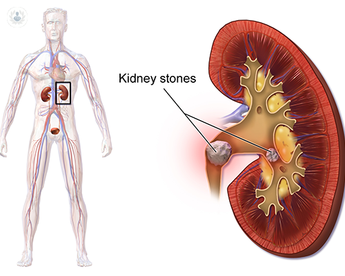 sabes-que-son-los-calculos-renales-o-piedras-en-el-rinon-descubre-cuales-son-sus-causas-sintomas-y-tratamiento-con-el-doctor-martin-oses