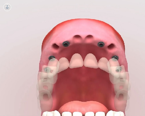 Fases para el tratamiento de los implantes dentales