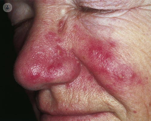 rosacea-tratamiento
