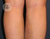 estrias-laser-vascular