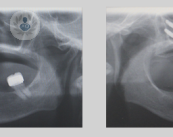 implantes-cigomaticos