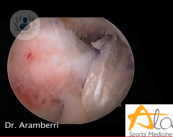 lesion-ligamentos-cruzados