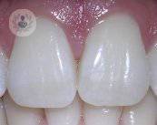 diente-endodoncia